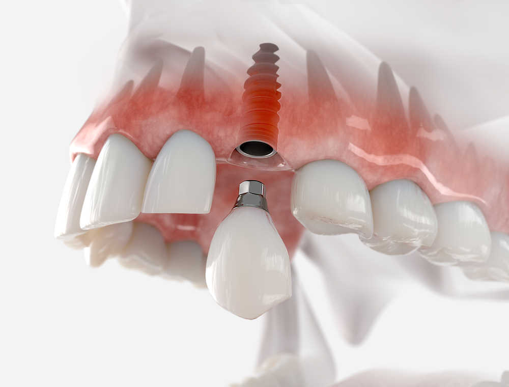 Implantes dentales y sus ventajas